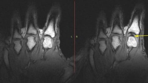 Röntgenbild Hände nach Fingerknacken